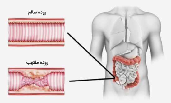 التهاب روده