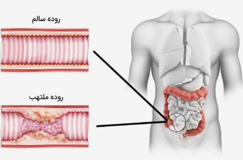  چه کسانی در خطر بروز بیماری التهابی روده (IBD) هستند؟