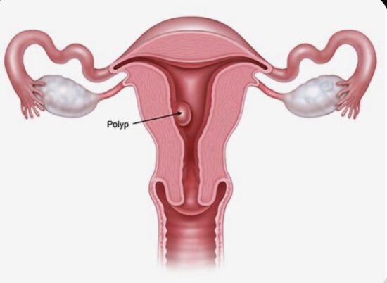 پولیپ رحم