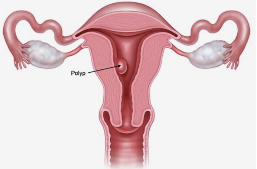  تشخیص عارضه پولیپ رحم و راه های درمان