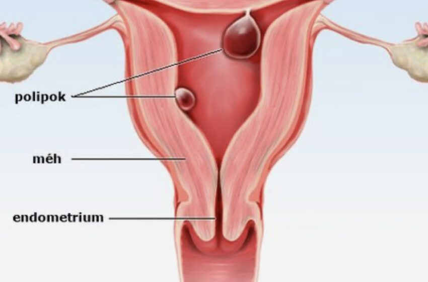  پولیپ رحم چیست و دلایل بروز پلیپ رحم